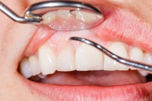 Dental Teeth