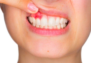 Gum Contouring & Teeth Reshaping