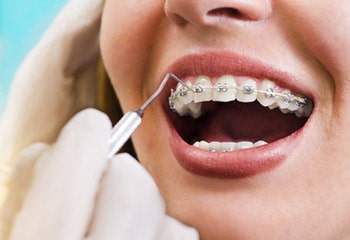Rubber Band Tips For Orthodontic Patients - Orthodontist Dublin