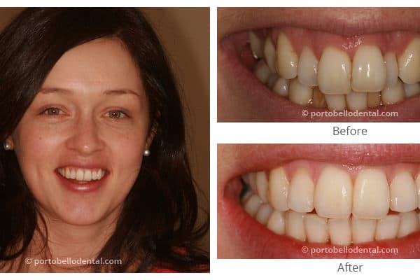Before and After - Smile Gallery