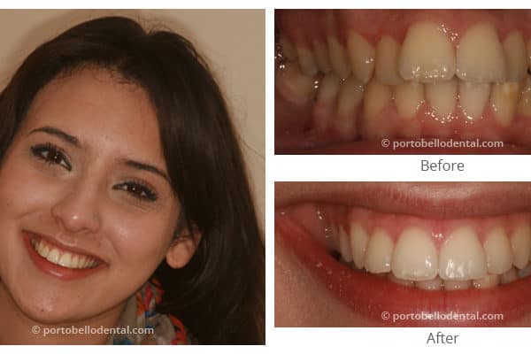 Before and After - Smile Gallery