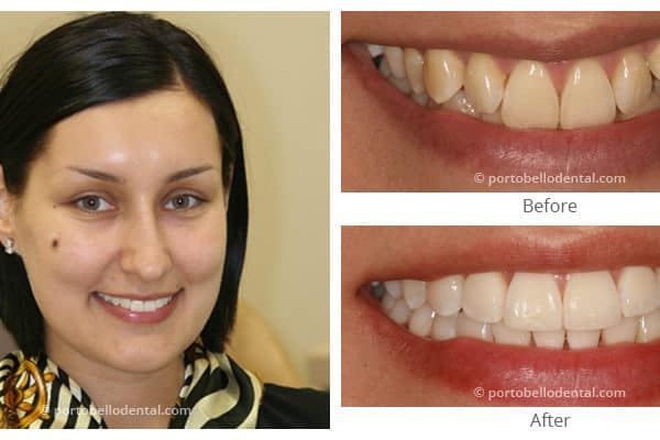 Before And After - Smile Gallery